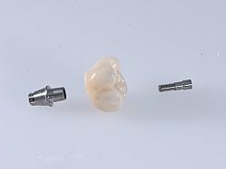 Zirconia Implant Crown With Titanium Base