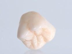 Zirconia Monolithic Crown