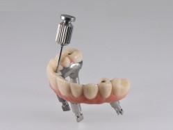 Angulate Screw Channel